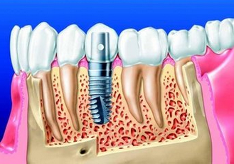 种植牙的优缺点