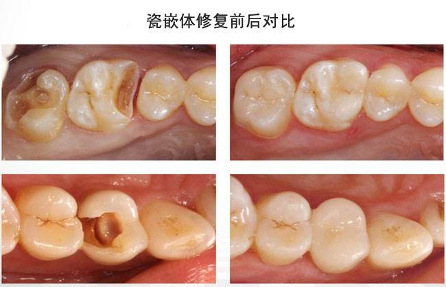 瓷嵌体的优势