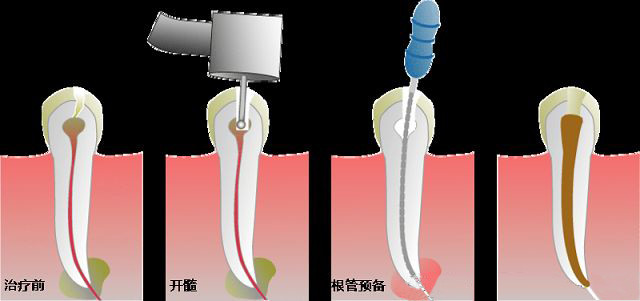 为什么患者需要做根管治疗