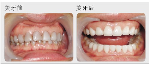 牙烟渍是如何去掉的